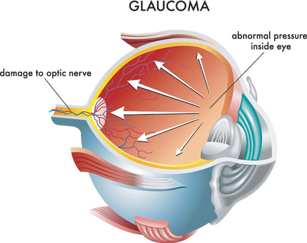 Glaucoma Causes 11570