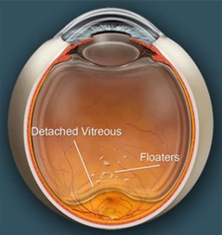 Eye Floaters: Laser Treatment, Symptoms, Causes