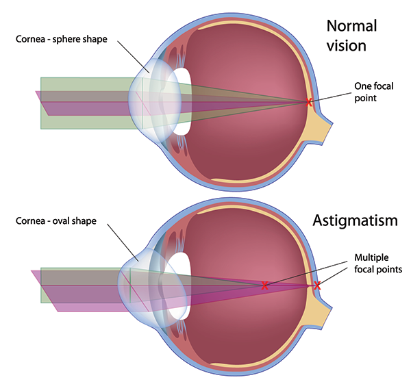 Astigmatism Causes 11570