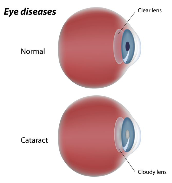 Cataract Treatment 11570
