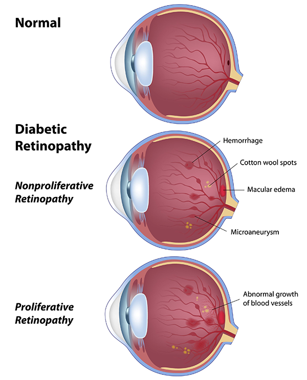 Diabetic Eye Care Rockville Centre