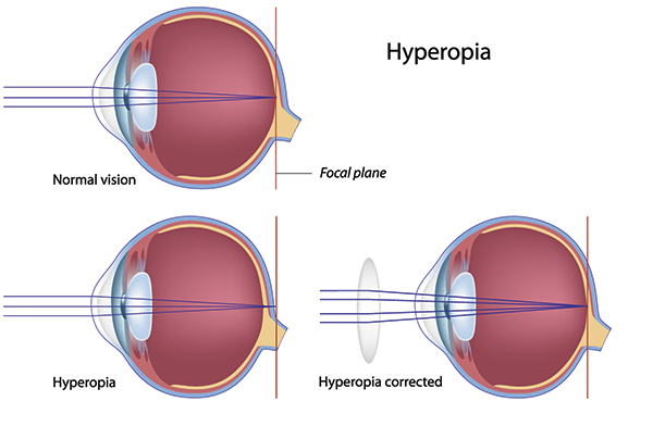 11570 Hyperopia