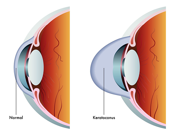 Keratoconus Rockville Centre