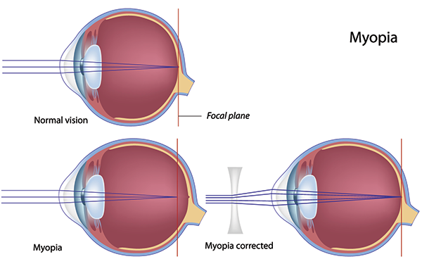 11570 Nearsightedness