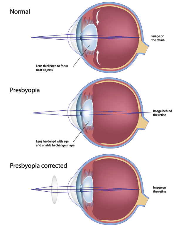 farsightedness in rockville centre