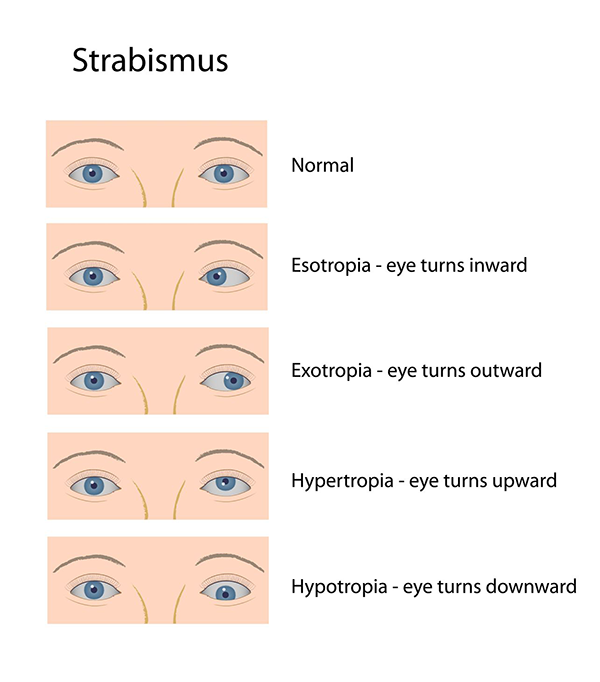 Strabismus Rockville Centre